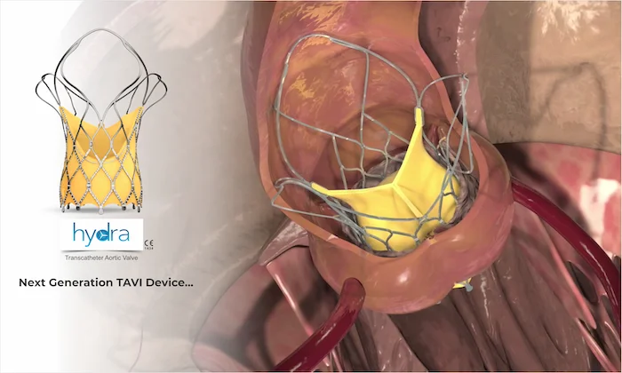 SMT Won the Italian National CONSIP 2-Year Tender to Supply Hydra TAVI in All Italian Hospitals<br>