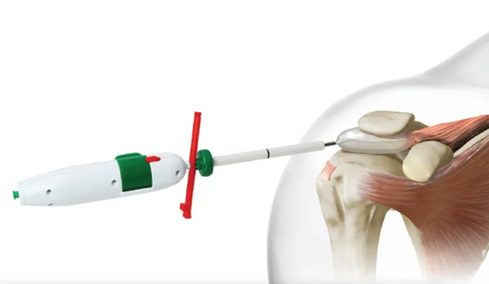 Stryker Launches InSpace, a First-of-Its-Kind Biodegradable Subacromial Balloon Implant, in India<br>