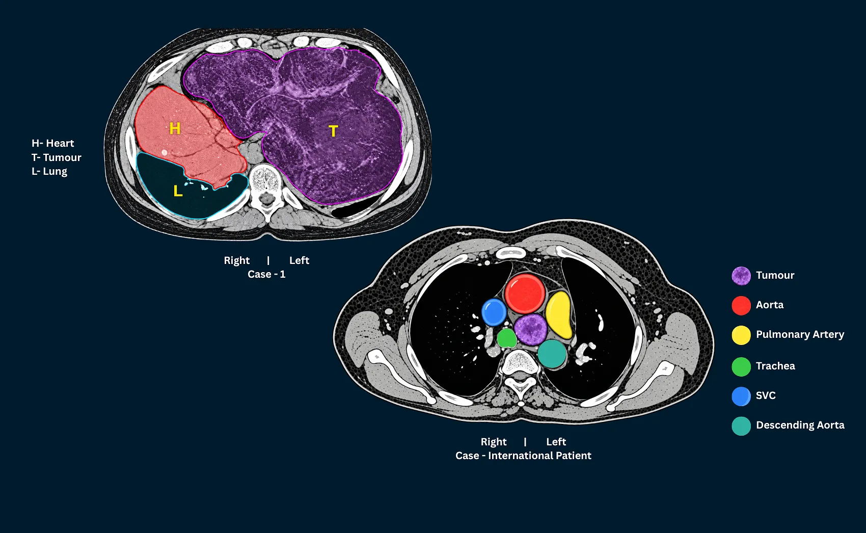 A Right-Sided Heart, A 3kg Tumour: A Rare Surgery at Zydus Hospital, Ahmedabad Gives An 11-Year-Old a New Life
